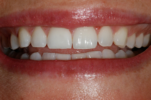 Tooth-Bleaching-After-1