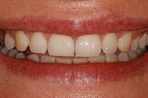 Tooth-Bleaching-Before-1