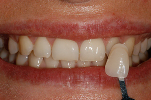 tooth-Bleaching-Before-2