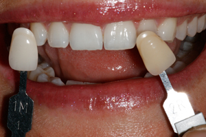 Tooth-bleaching-after-2
